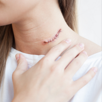 Massage et Automassage cicatriciel